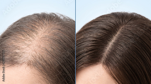 Comparison of thinning hair and thick healthy scalp hair growth