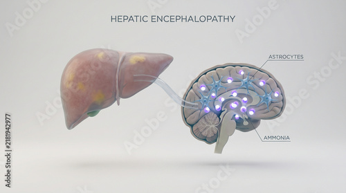 Medical illustration of hepatic encephalopathy and the effect of ammonia