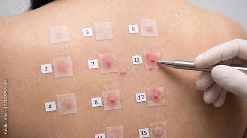 Dermatologist Conducting Allergy Patch Test on Patient Back in Clinic