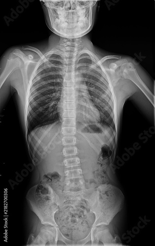 Pediatric scoliosis X-ray of full spine with thoracic curvature, vertebral rotation and shoulder asymmetry