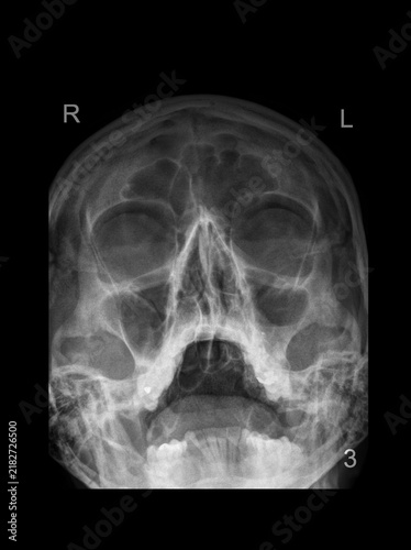 Adult skull X-ray of paranasal sinuses for sinusitis diagnosis and medical examination