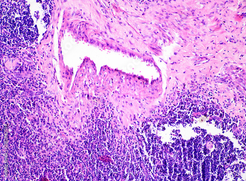 Foto Tuberculosis is a chronic granulomatous inflammation characterized pathologically by tuberculous nodules, which consist of caseous necrosis, epithelioid cells, and macrophages