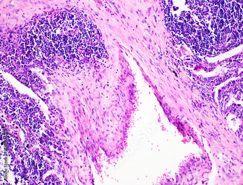 Obraz na plátne Tuberculosis is a chronic granulomatous inflammation characterized pathologically by tuberculous nodules, which consist of caseous necrosis, epithelioid cells, and macrophages