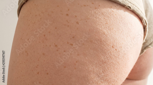 Close Up of Dense Natural Freckles and Sun Spots on Woman Hip and Thigh