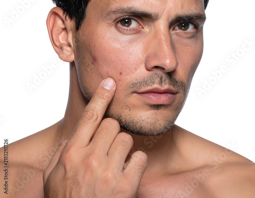 Man touching acne blemish on cheek examining skin care problem close up face.