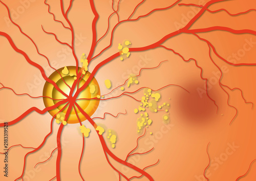 Dry macular degeneration, illustration
