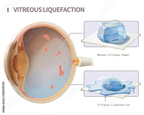 Vitreous thinning, illustration