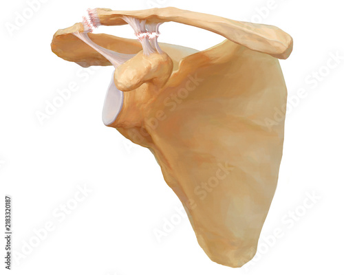 Acromioclavicular dislocation type III, illustration