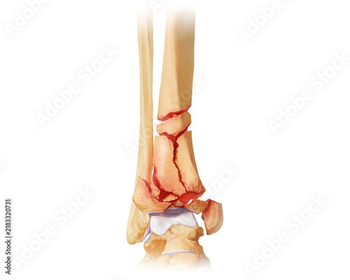 Distal tibia fracture AO-C3.2, illustration