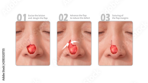 Forehead flap combined with integration, illustration