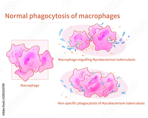 Tuberculous mastitis macrophage phagocytosis, illustration