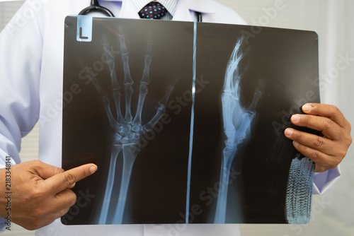 Bild auf Leinwand Doctor examining hand ankle joint bone radiography xray film.