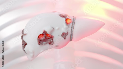Liver white color that is being attacked or destroyed. Fatty liver disease or liver cancer concepts abnormal tissue or lumps of fat. for medical education. Minimal idea concept, 3D render.