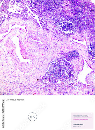 Konstfotografi Tuberculosis is a chronic granulomatous inflammation characterized pathologically by tuberculous nodules, which consist of caseous necrosis, epithelioid cells, and macrophages