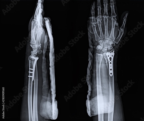 Foto Distal Radius Fracture X-Ray Showing Volar Locking Plate Fixation and Cast Immob