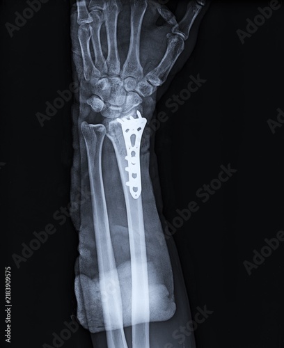 Canvas Print AP Forearm Radiograph Displaying Distal Radius Volar Plating with Immobilization
