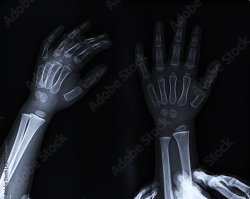 Obraz na plátne Pediatric Hand and Wrist Radiograph Showing Open Growth Plates