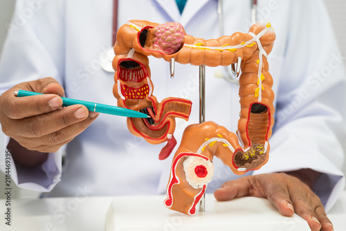 Принти на полотні Colorectal cancer, doctor holding intestine colon human model.