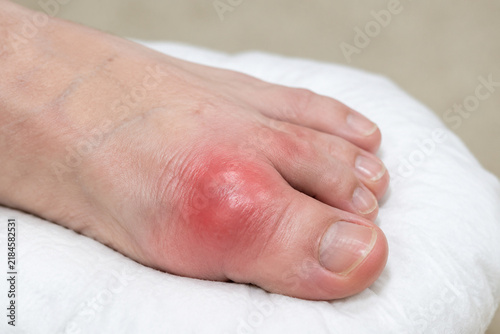 Swollen big toe joint on white cushion, gout and inflammation concept