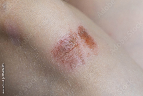 Close up view of scraped skin on human knee showing an abrasion wound, with visible red and raw areas, indicating fresh injury or beginning of healing process, detailed macro