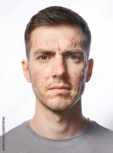 Front-facing close up portrait of a serious adult man with problematic acne-prone skin, photographed with studio lighting. She is looking directly at the camera, Light coming from both sides.