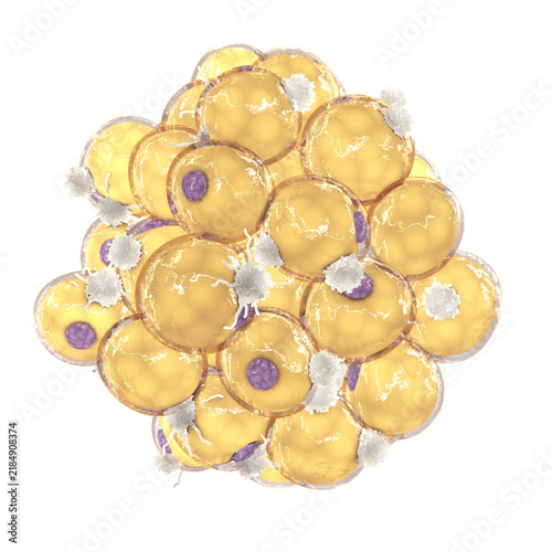 Activated macrophages surround swollen fat cells within inflamed adipose tissue. This localized immune response releases pro-inflammatory cytokines and drives chronic metabolic dysfunction