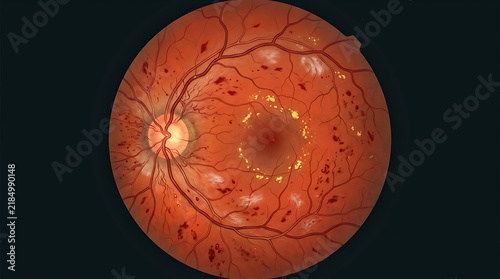 Detailed Medical Illustration of Retinal Disease Showing Blood Vessel Damage and Macular Exudates for Healthcare Research and Ophthalmology