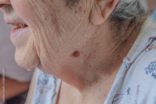 Wrinkles and age spots appear on the skin of an elderly woman. There is a small red spot on her neck.