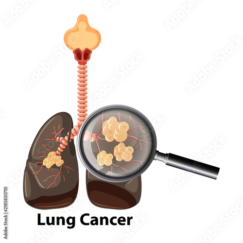 Fotografie Human lung cancer isolated on a transparent background