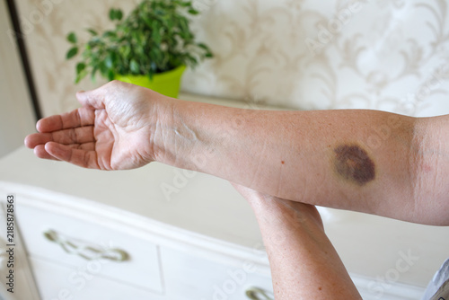 Foto Bruise on arm after unsuccessful blood draw, hematoma from venipuncture with glo