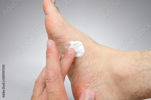 Man applying moisturizing cream to dry foot skin close-up on grey background