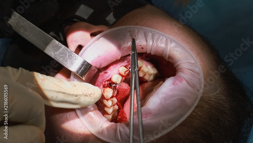 Bild auf Leinwand Close-up oral treatment showing dental instruments and a drill being used on the