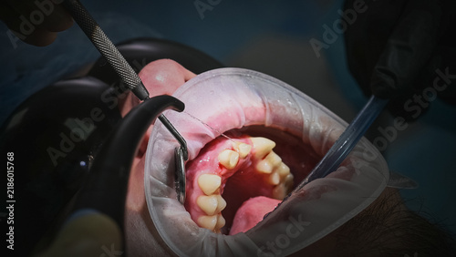 Foto Close-up oral treatment showing dentist using dental drill and instruments on pa