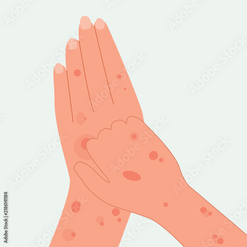 Woman suffering from strong allergy skin itchy symptom in flat design. Red rash skin irritation. vector illustration