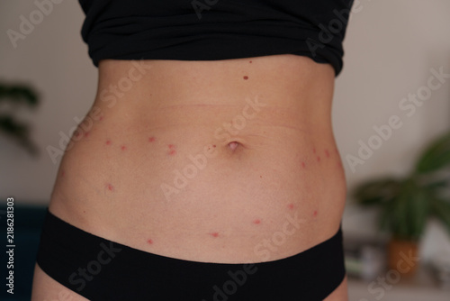 Harvest mite bites causing red itchy rash on woman abdomen