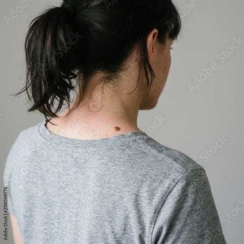 Obraz na płótnie Close Up Of A Woman's Neck Showing A Mole