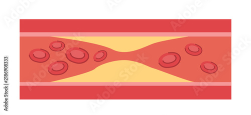 Konstfotografi Atherosclerosis in Blood Vessel