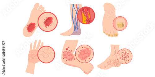 World Diabetes Day Illustration