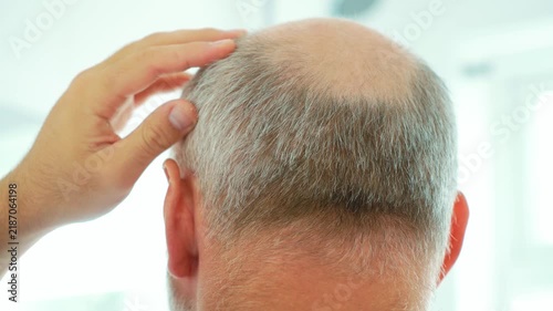 Balding senior man touching head with thinning gray hair and bald spot. Male pattern hair loss and receding hairline in mature age. Alopecia, graying hair and aging problem in close up rear view
