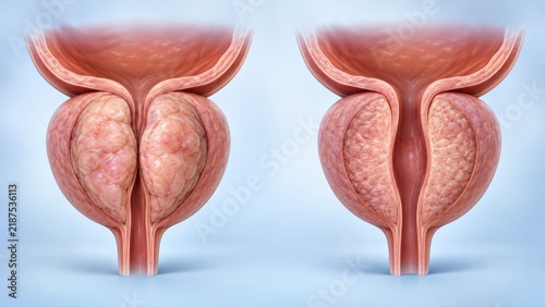 Benign prostatic hyperplasia shown before and after treatment in premium clinical CGI with urethral compression versus improved urinary channel on pale blue urology background.