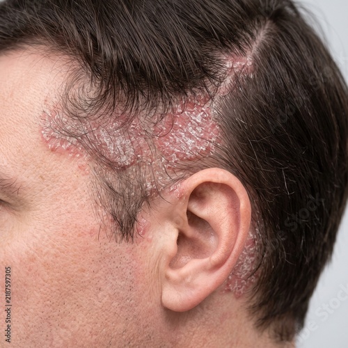 Scalp Psoriasis With Scaly Inflamed Skin, Chronic Dermatological Condition