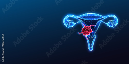 Glowing neon polygonal uterus shows a malignant tumor representing cervical cancer. 