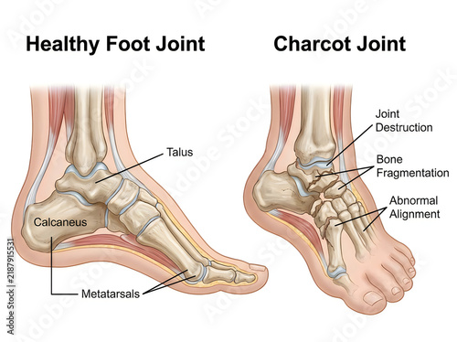 Charcot Foot Neuropathic Arthropathy Comparison with Healthy Joint Medical Illustration Showing Bone Fragmentation and Joint Destruction Isolated