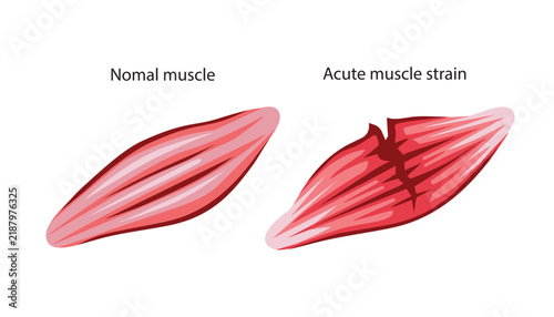 Acute Muscle Strain and Tear Illustration