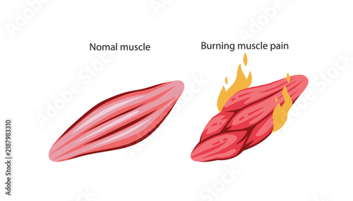 Burning Muscle Pain Illustration