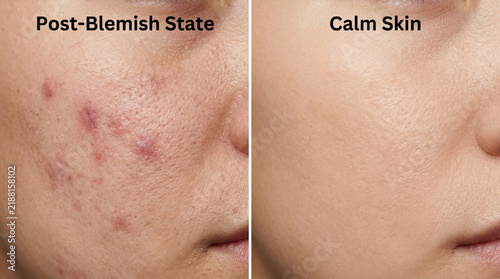 Acne Scarring vs Clear Skin Comparison
