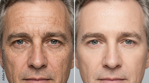 Aging Skin Transformation: Before and After Comparison