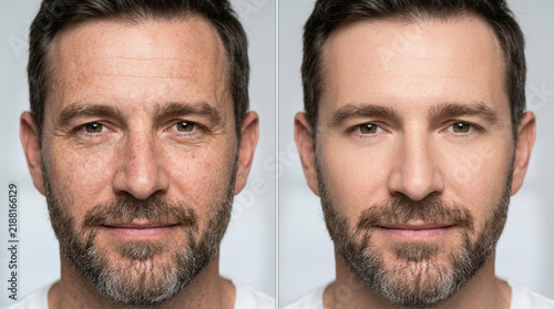 Before and After Anti-Aging Treatment for Men: Wrinkles vs Smooth Skin