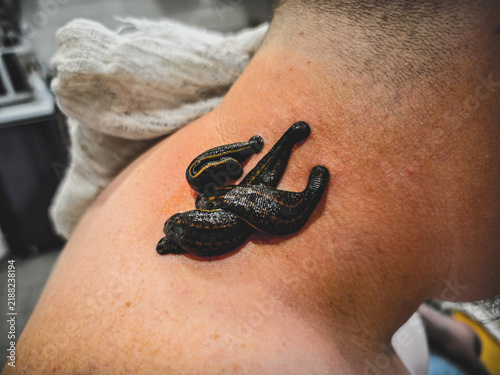 Obraz na płótnie Medicinal leeches performing hirudotherapy treatment on a man's neck, using a bloodletting technique as an alternative medicine approach for wellness and detoxification