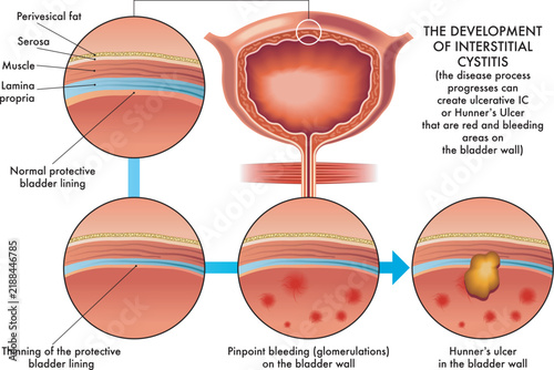 Medical illustration of the stages of development of interstitial cystitis.